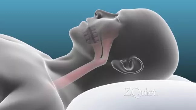ZQuiet Anti-Snoring Mouthpiece – Single Pack
